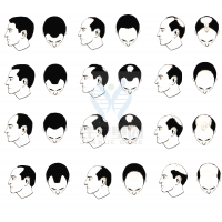 【MG冰球突破官网基因检测】过早<font color='red'>脱发</font>、掉发太多怎么办？你的方法可能是错的！